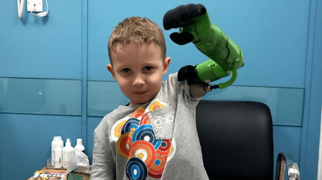 5-летнему мальчику поставили уникальный протез руки