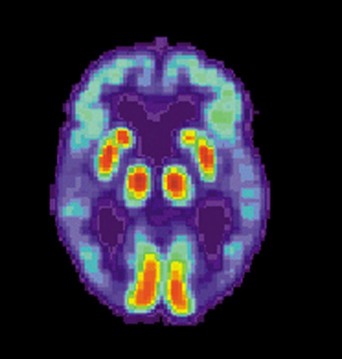 Придумали, как диагностировать болезнь Альцгеймера по снимкам МРТ головного мозга