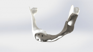 Впервые имплантировали 3D-напечатанную челюсть, которую создали на основе КТ и МРТ пациента